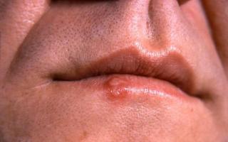 Профілактика герпесу на губах: таблетки